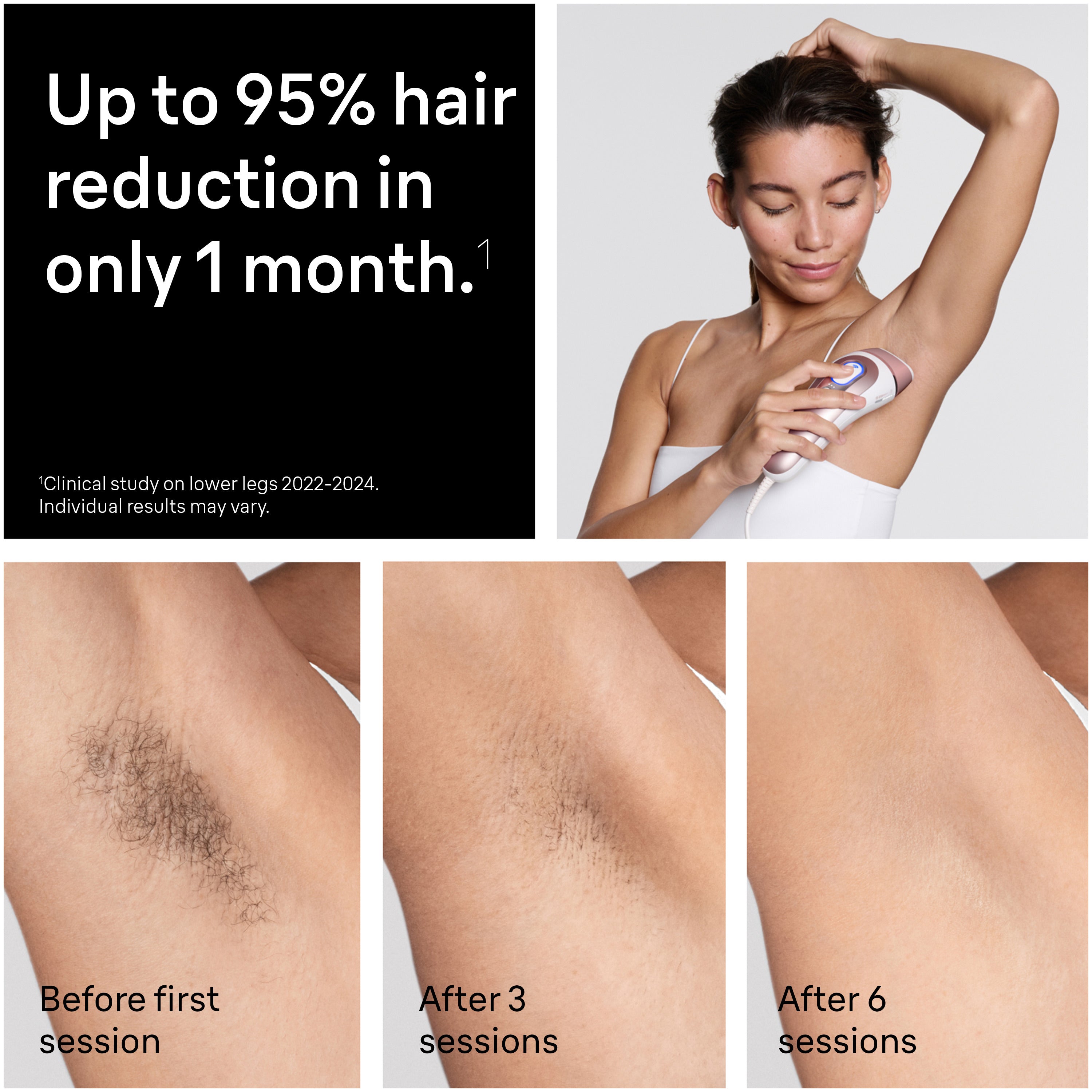 Braun Skin i·expert Smart IPL: At Home Alternative to Laser Hair Removal with 4 Caps and Vanity Case PL7387